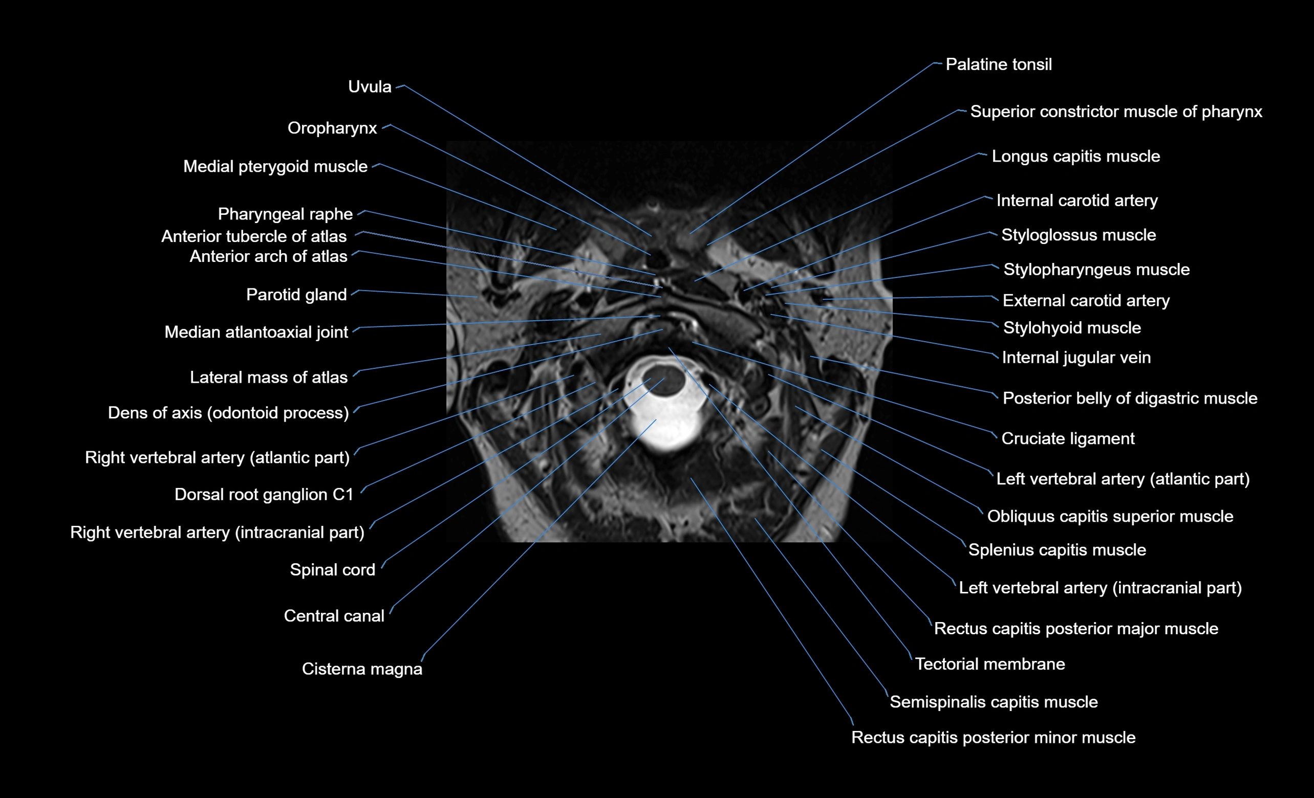 cervical spine cross sectional MRI anatomy  3T MRI axial  image-img-00001-00004.webp